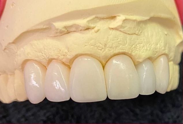 carillas-dentales-prueba