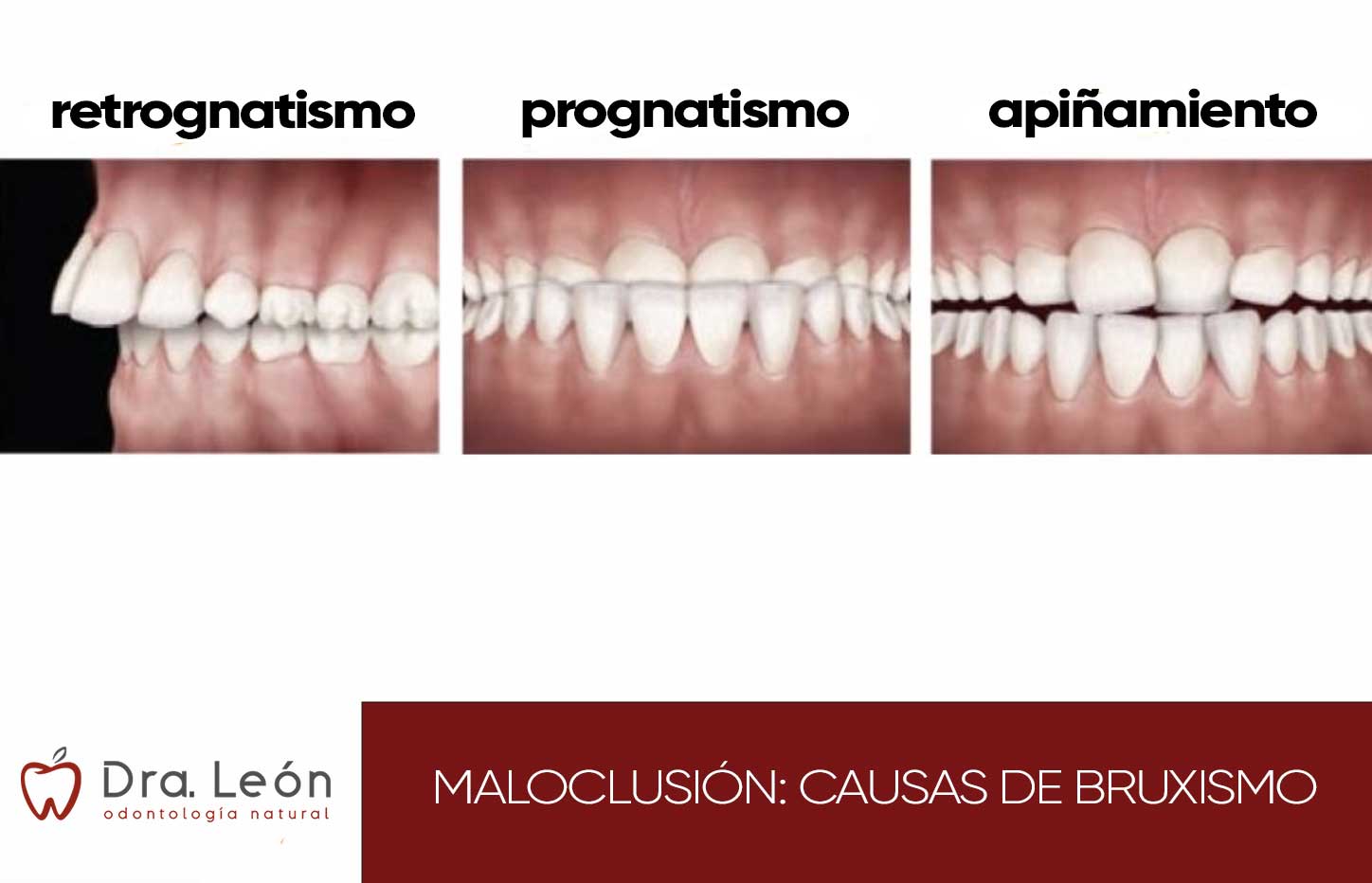maloclusión como causa de bruxismo