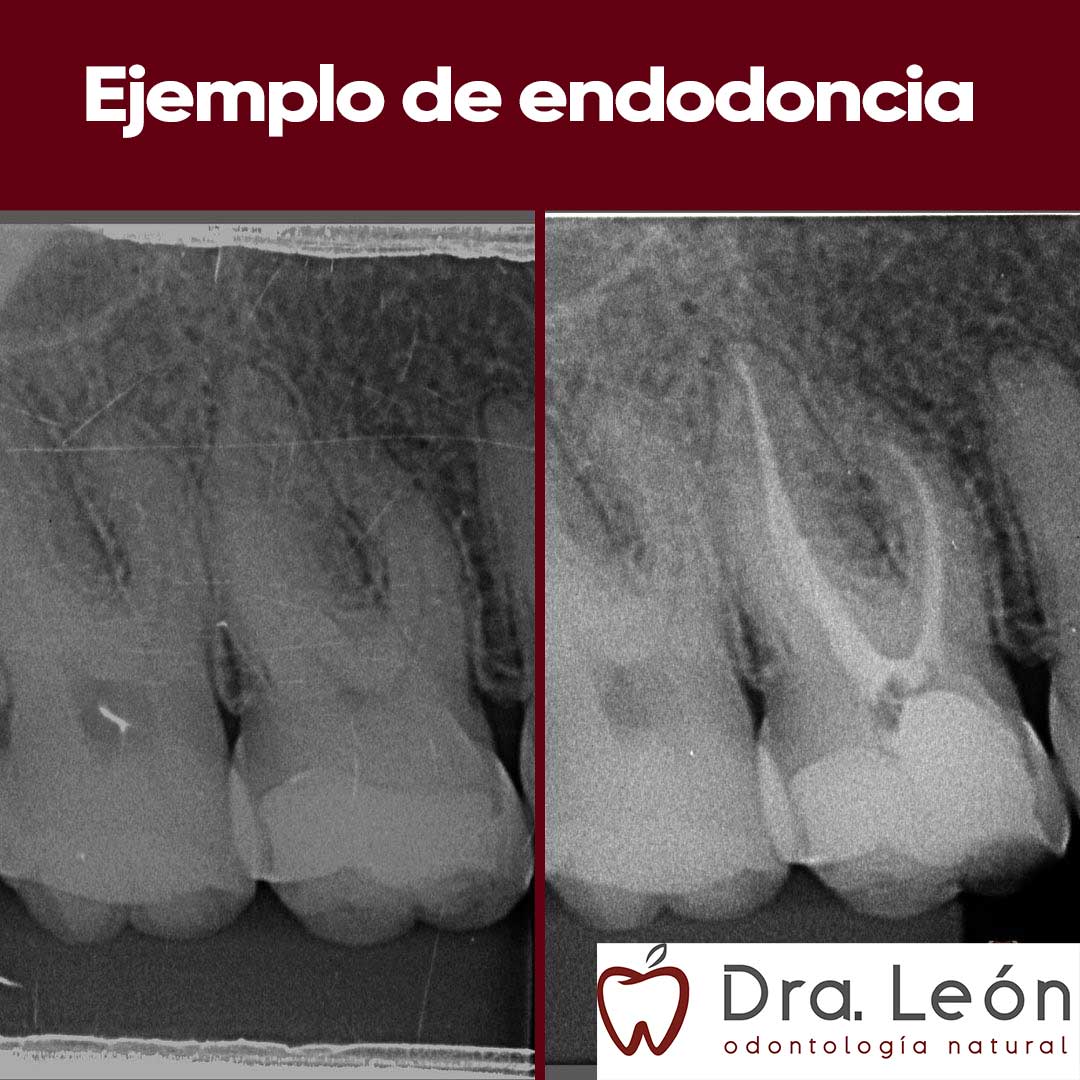 ejemplo-endodoncia-madrid