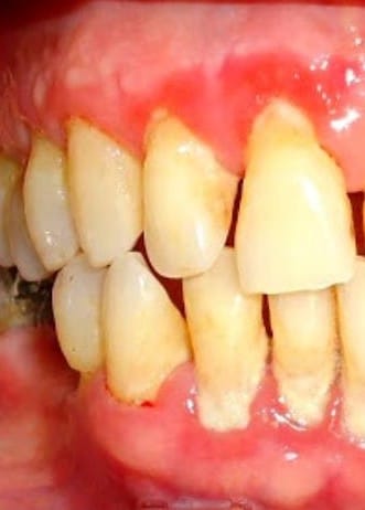 ejemplo-enfermedad-periodontal