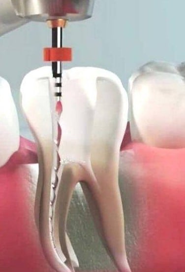 endodoncia-tratamiento-madrid