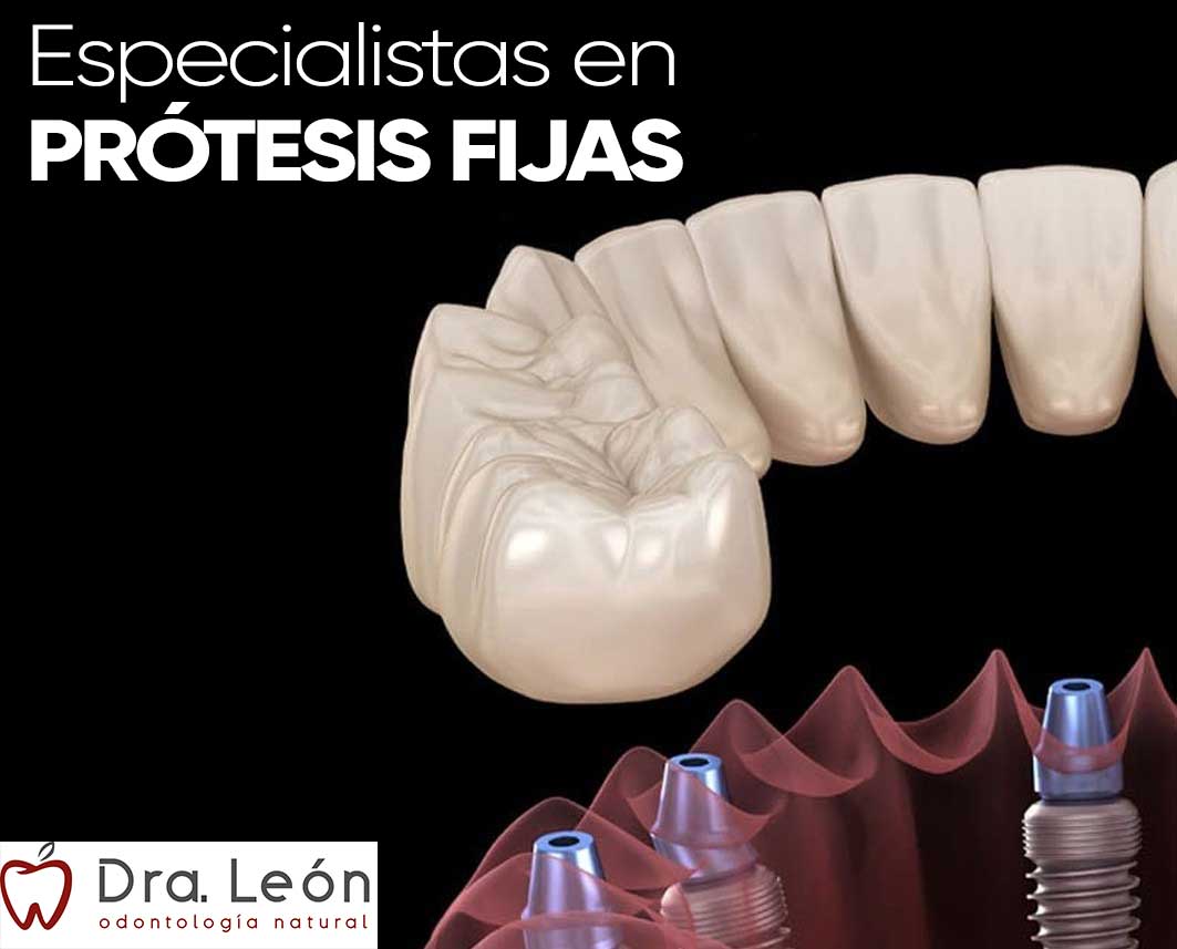 Especialistas en prótesis fijas sobre implantes dentales Madrid