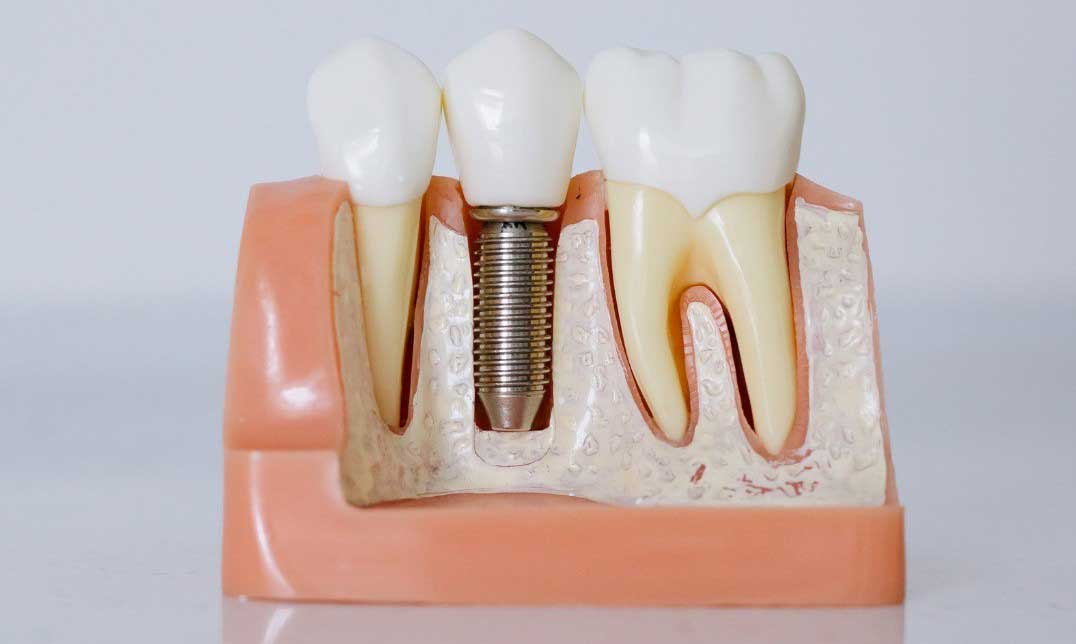 implantes-dentales-madrid