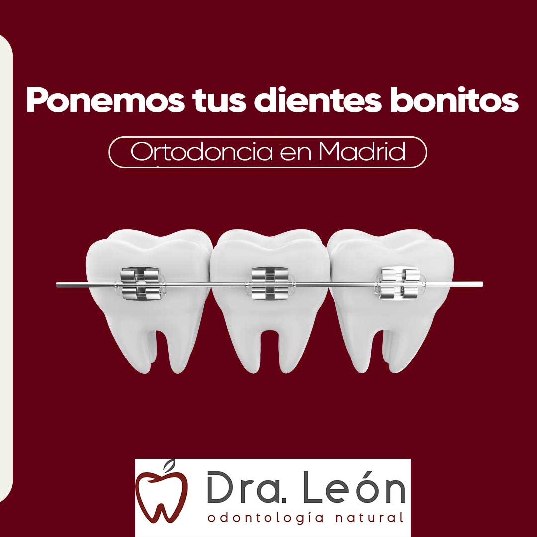 Precio de ortodoncia en Madrid