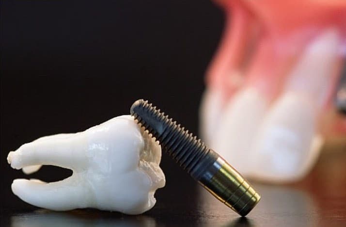 precio-implantes-dentales-madrid