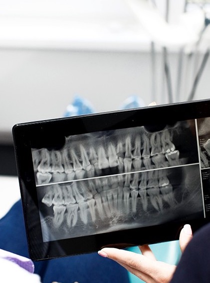 protesis-fija-implantes-diagnostico