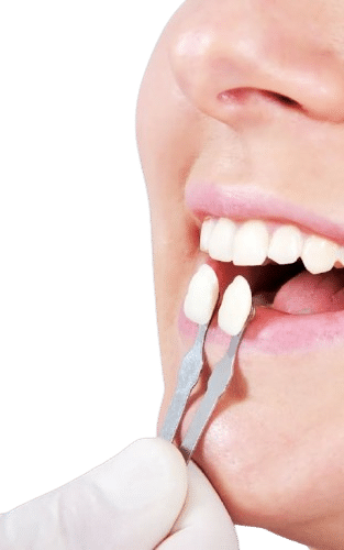 tratamiento de carillas dentales en Madrid