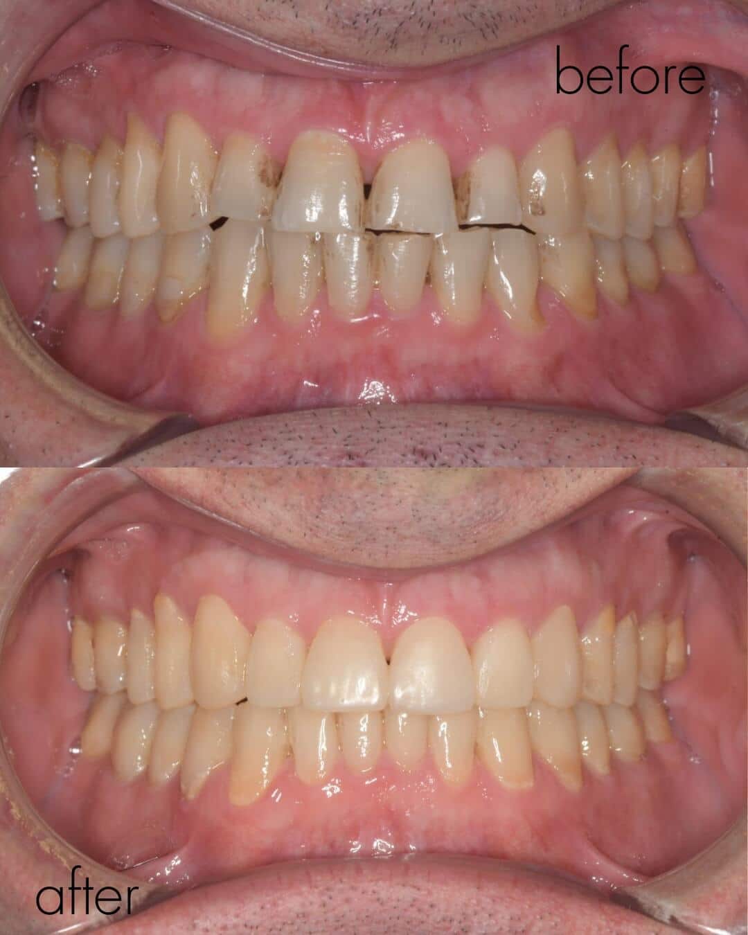 Foto antes y después bruxismo Madrid