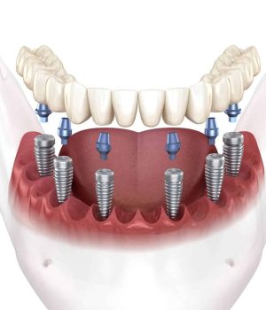 protesis-fija-sobre-implantes protesis-fija-sobre-implantes